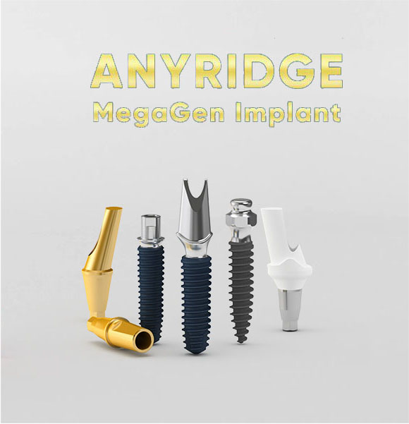 „AnyRidge® MegaGen“ Implantas su Cirkonio Keramikos Vainikėliu